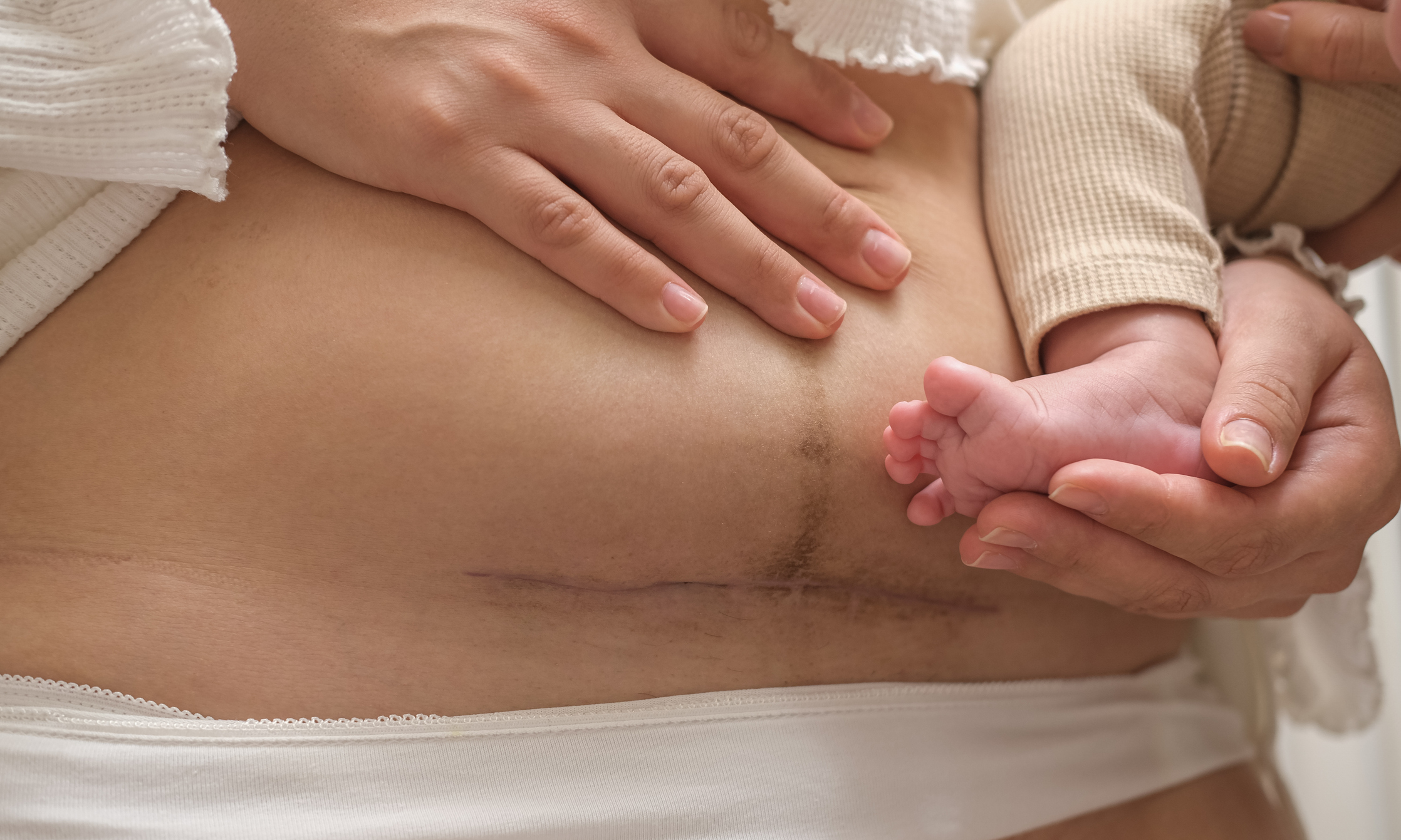 Scar on the abdomen after cesarean section