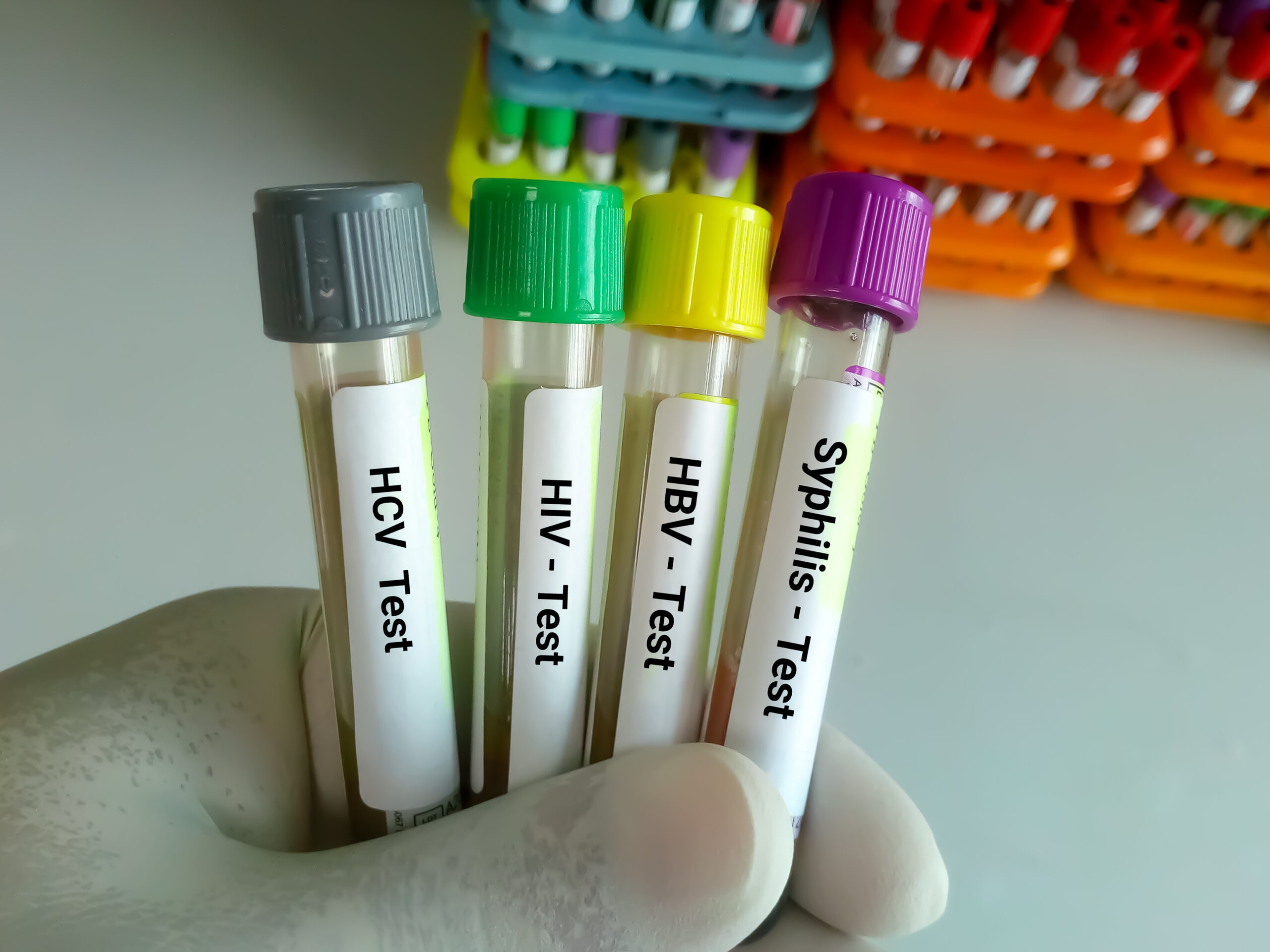 Scientist hold blood samples tube for Sexuallly Transmitted Disease. Syphilis, HBV, HIV, HCV
