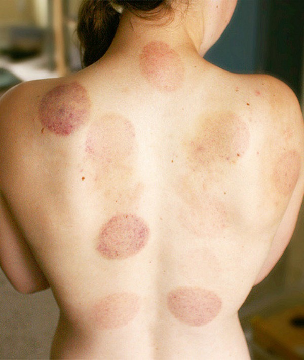 155101-woman-with-cupping-marks-on-back.jpg