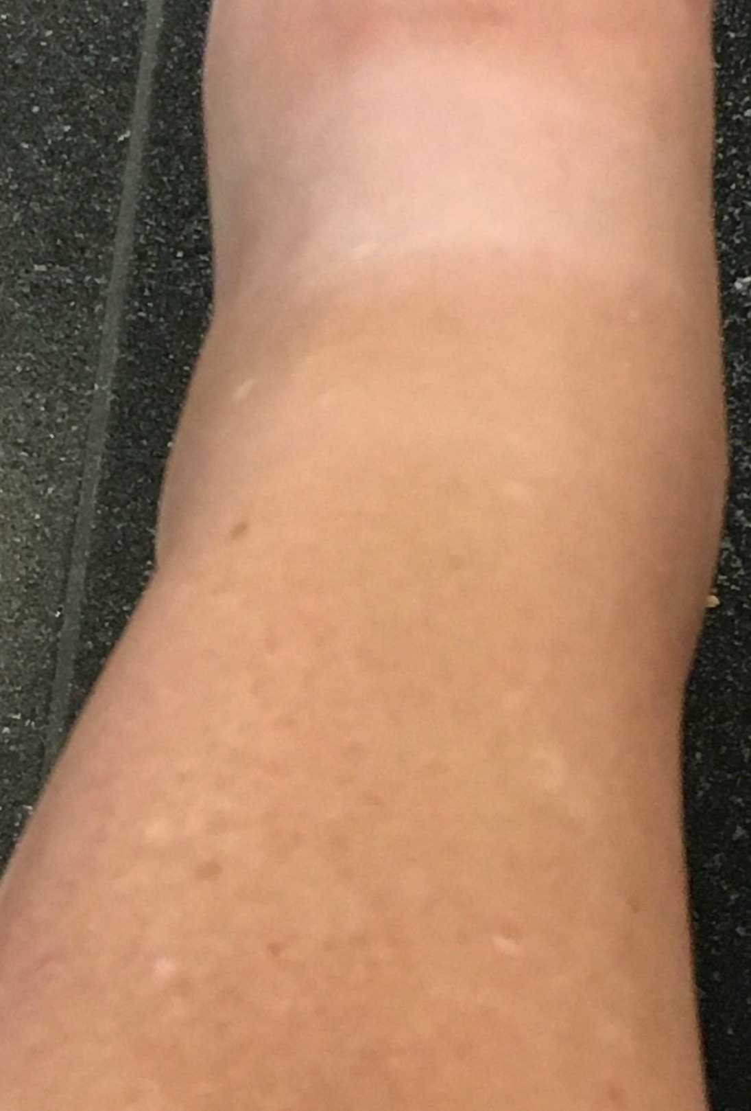 171710-swollen.jpg
