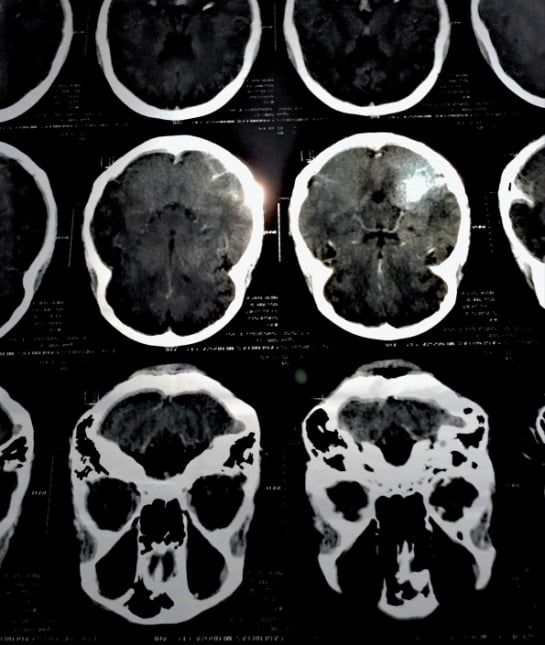 189709-health-breakthroughs-longer-life-gamma-knife.jpg