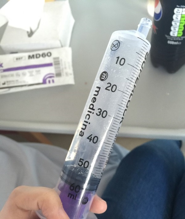 221626-irrigation-syringe.jpg