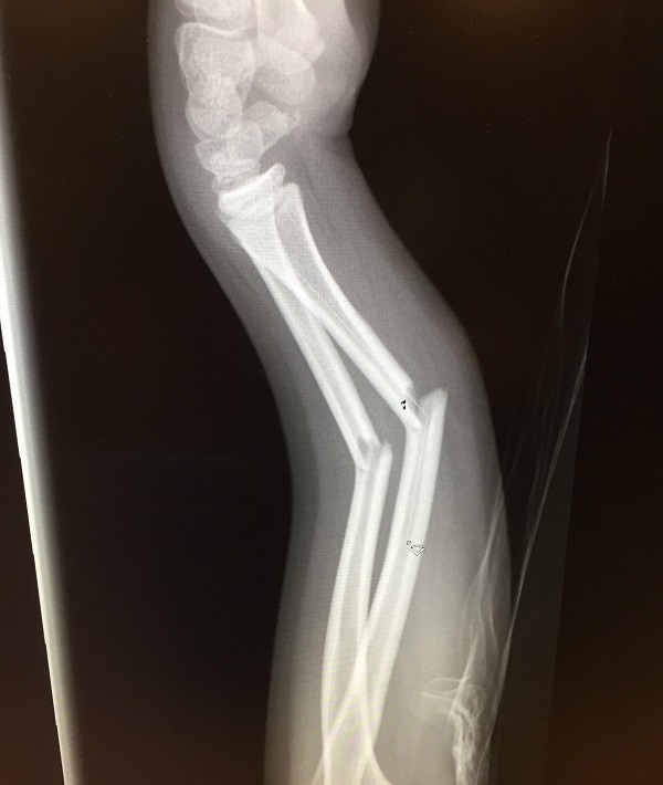 227052-fracture.jpg