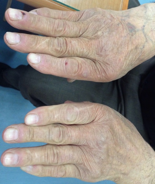 227056-arthritis.jpg