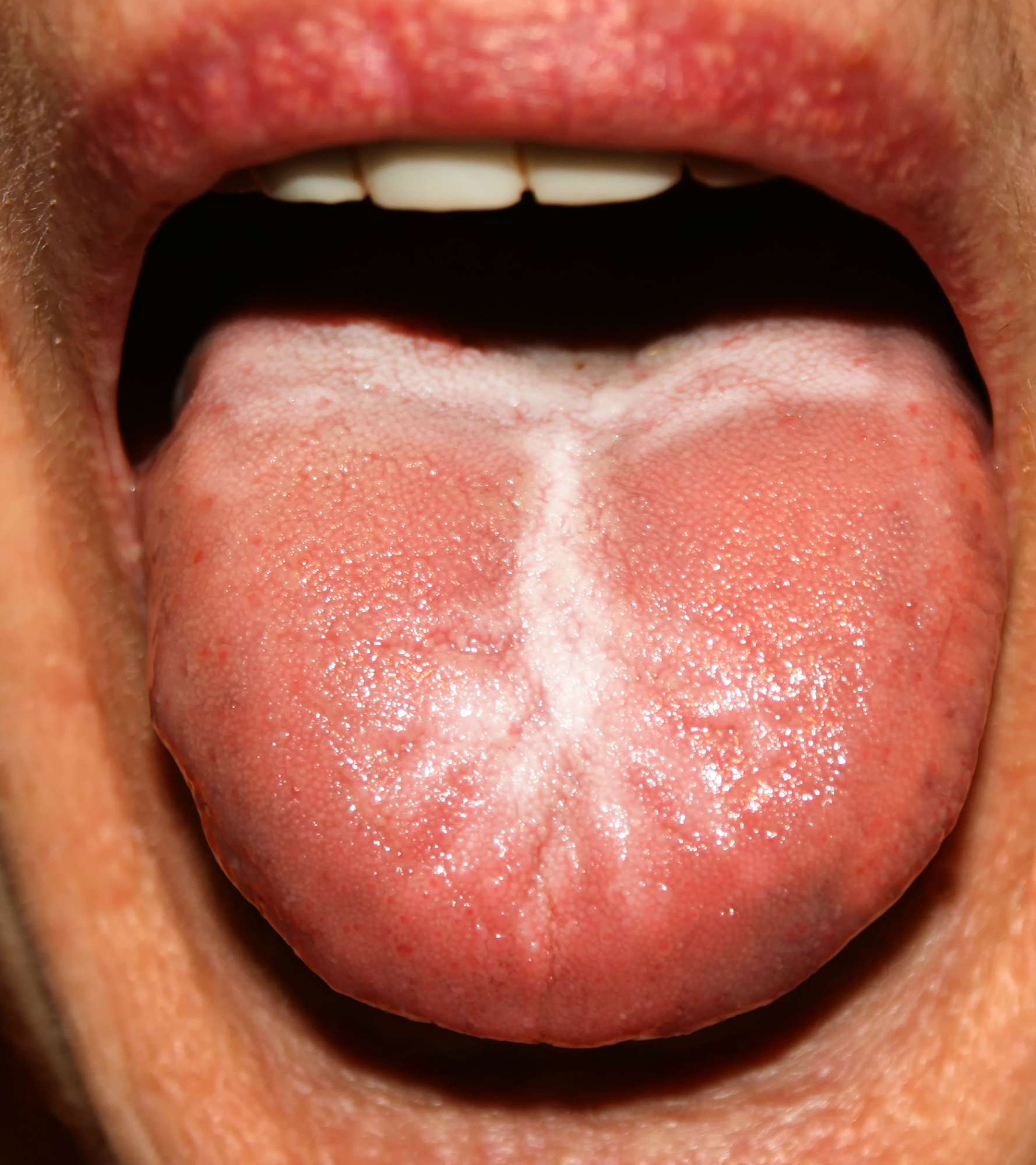Candidiasis in the tongue. White coating. Thrush