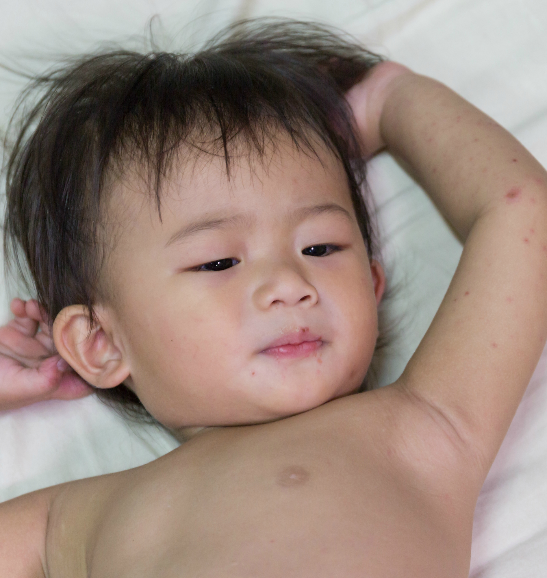 Asian baby infected, hand foot and mouth disease.