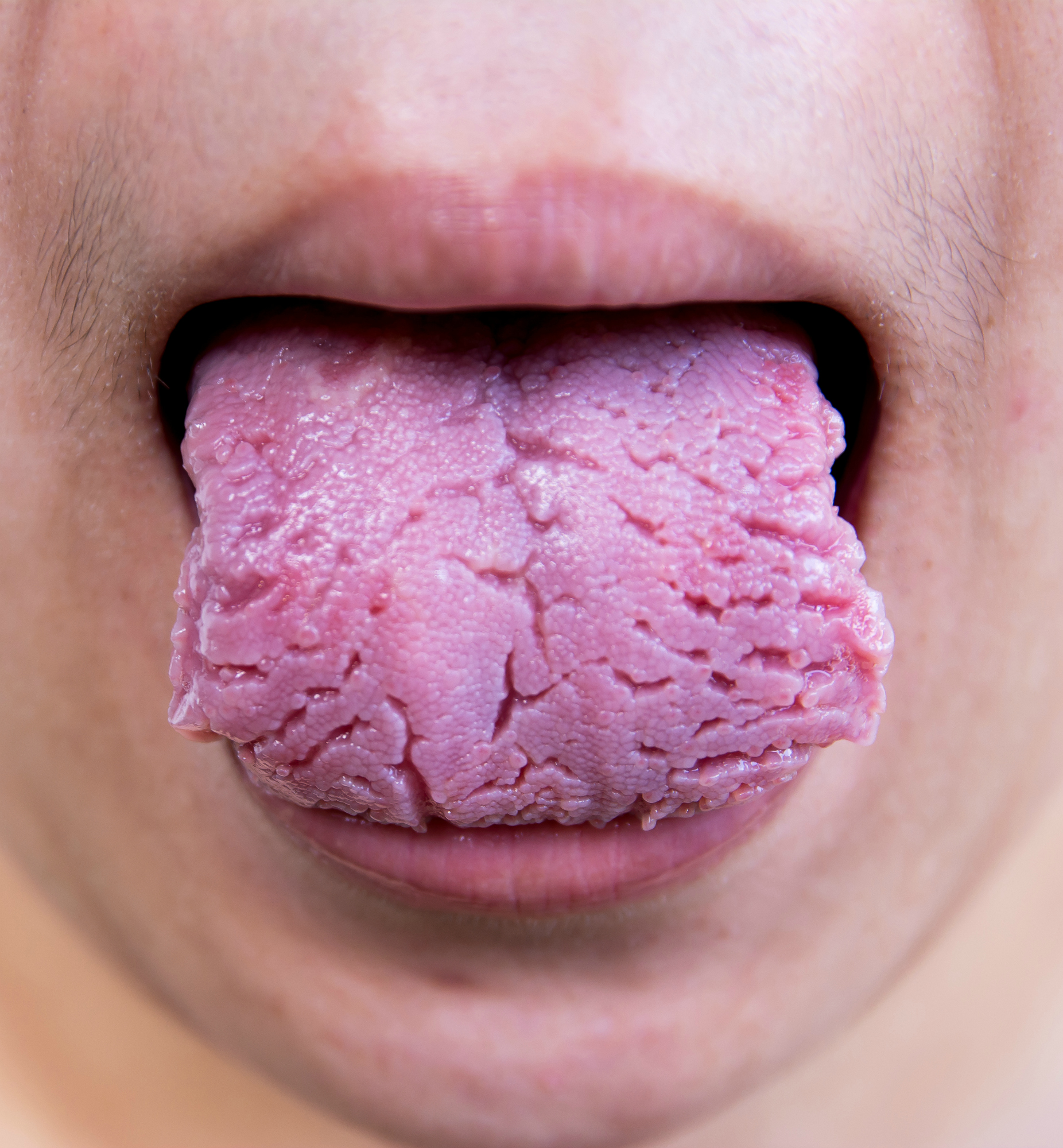 248814-health-problems-tongue-fissured.jpg
