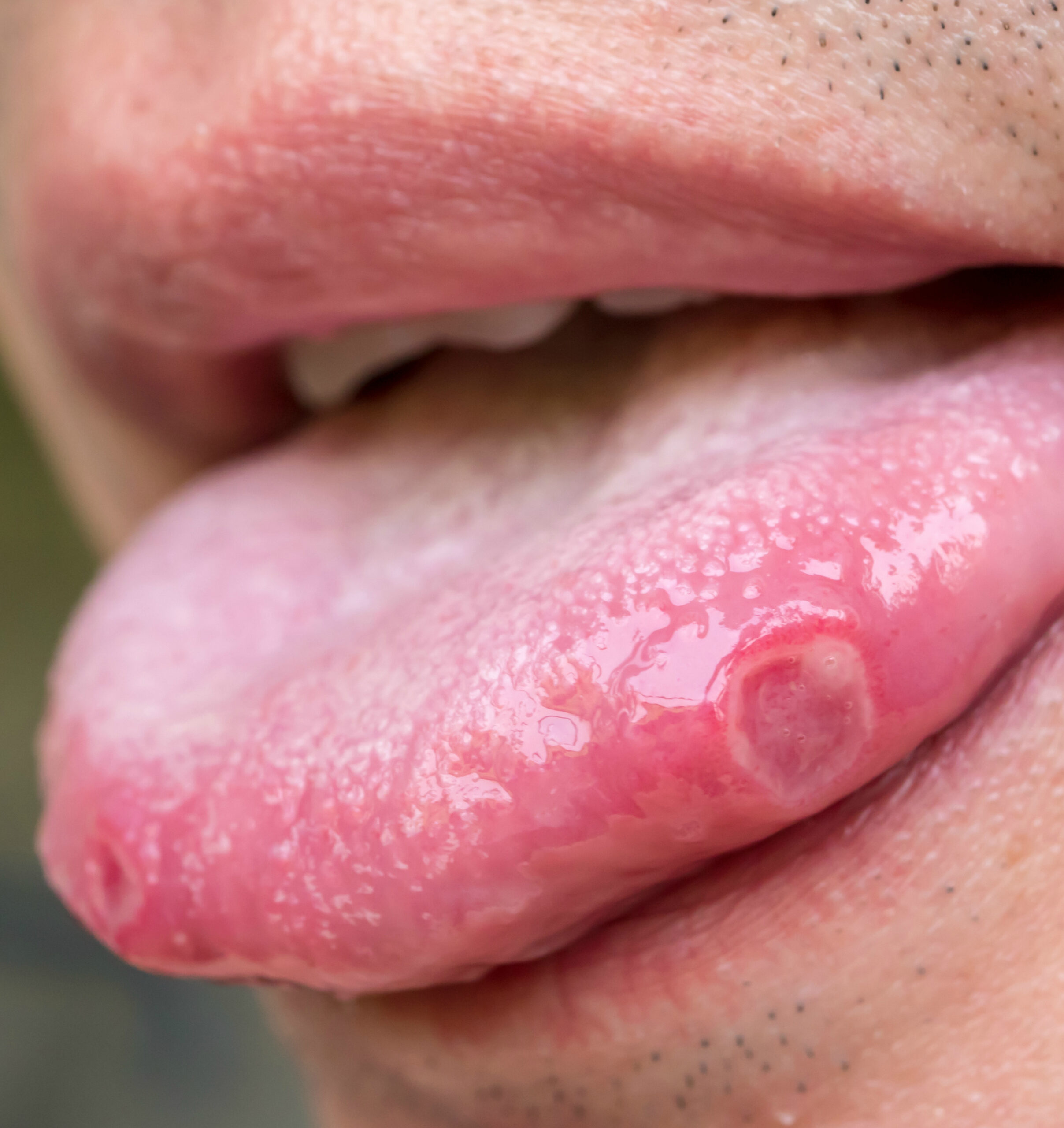 tongue with ulcers of adult man