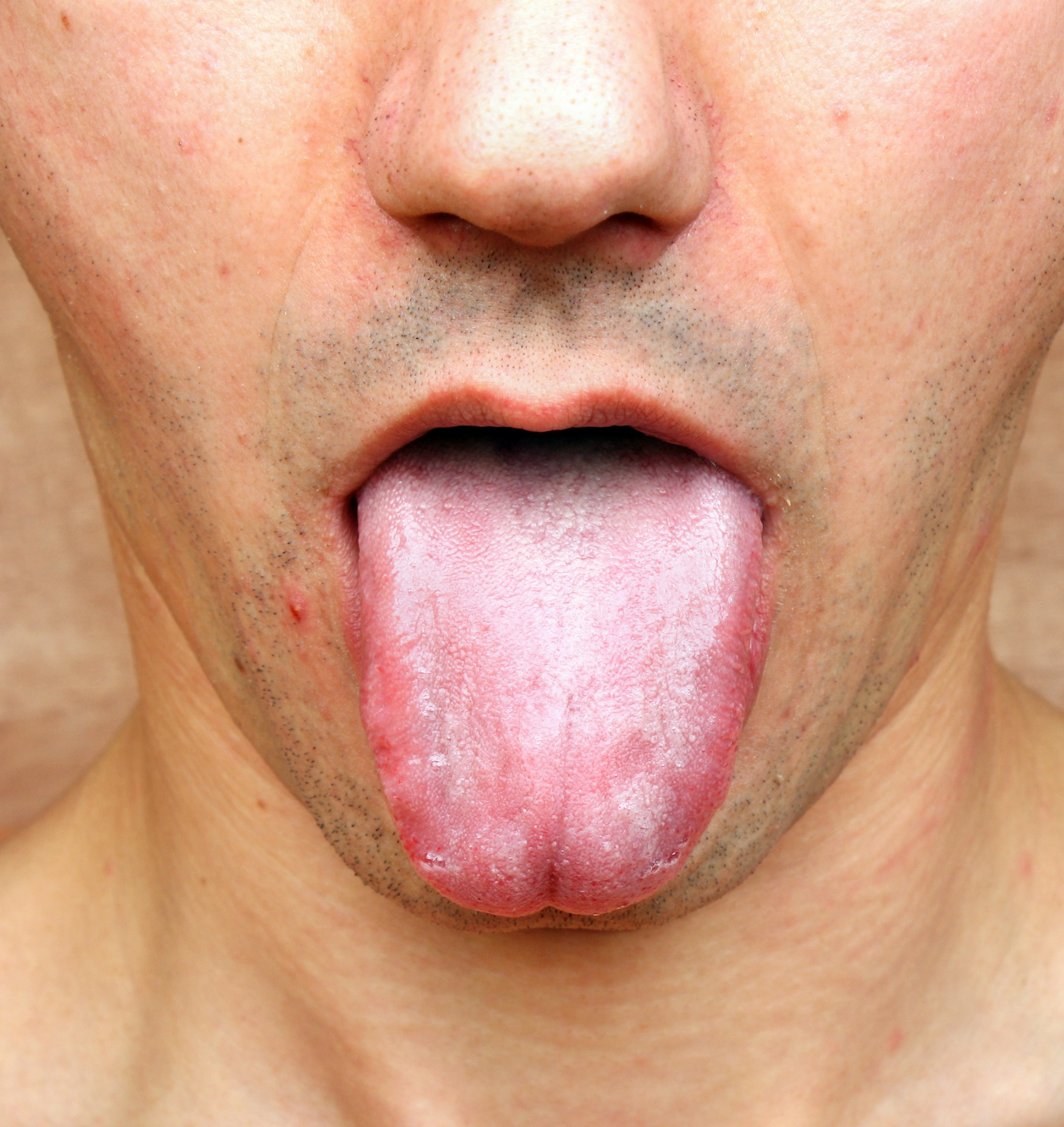 248818-health-problems-tongue-lichen-planus.jpg