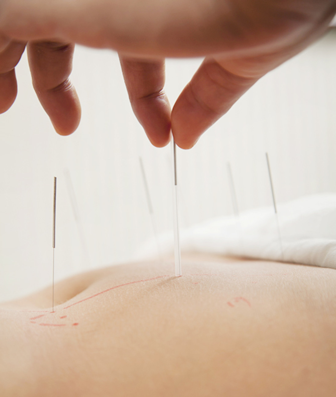 84260-9-fertility-booster-acupuncture.jpg