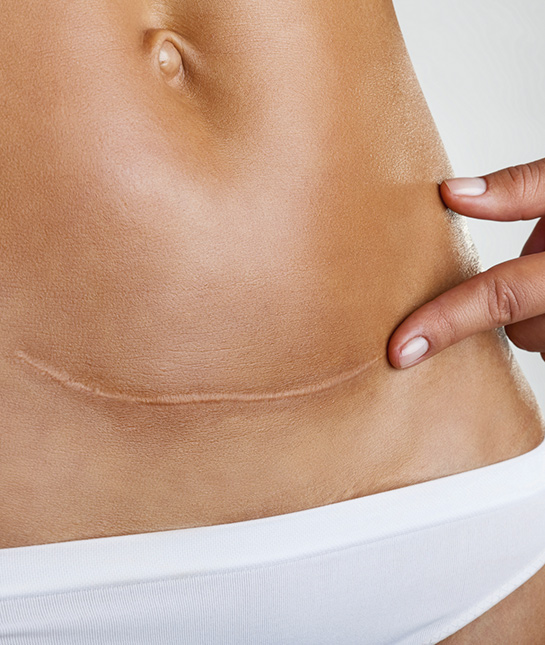 85979-c-section-hurts-scar.jpg