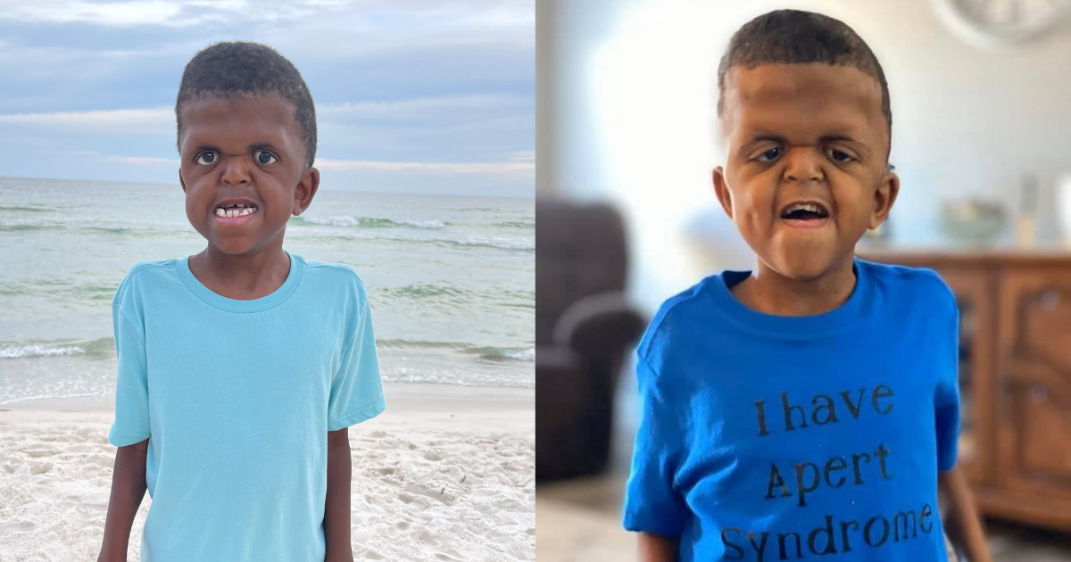 apert syndrome