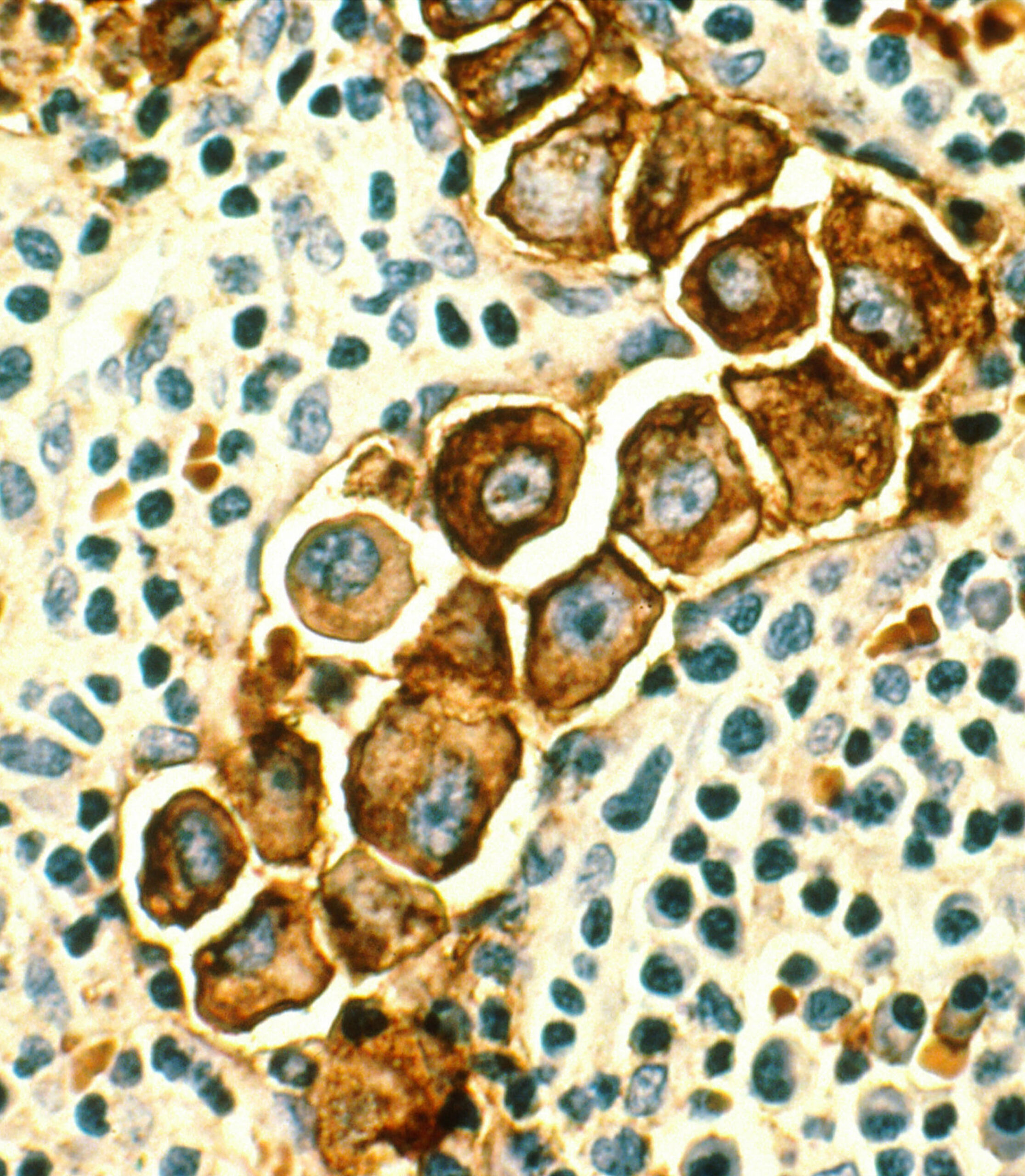 Breast Cancer Histology