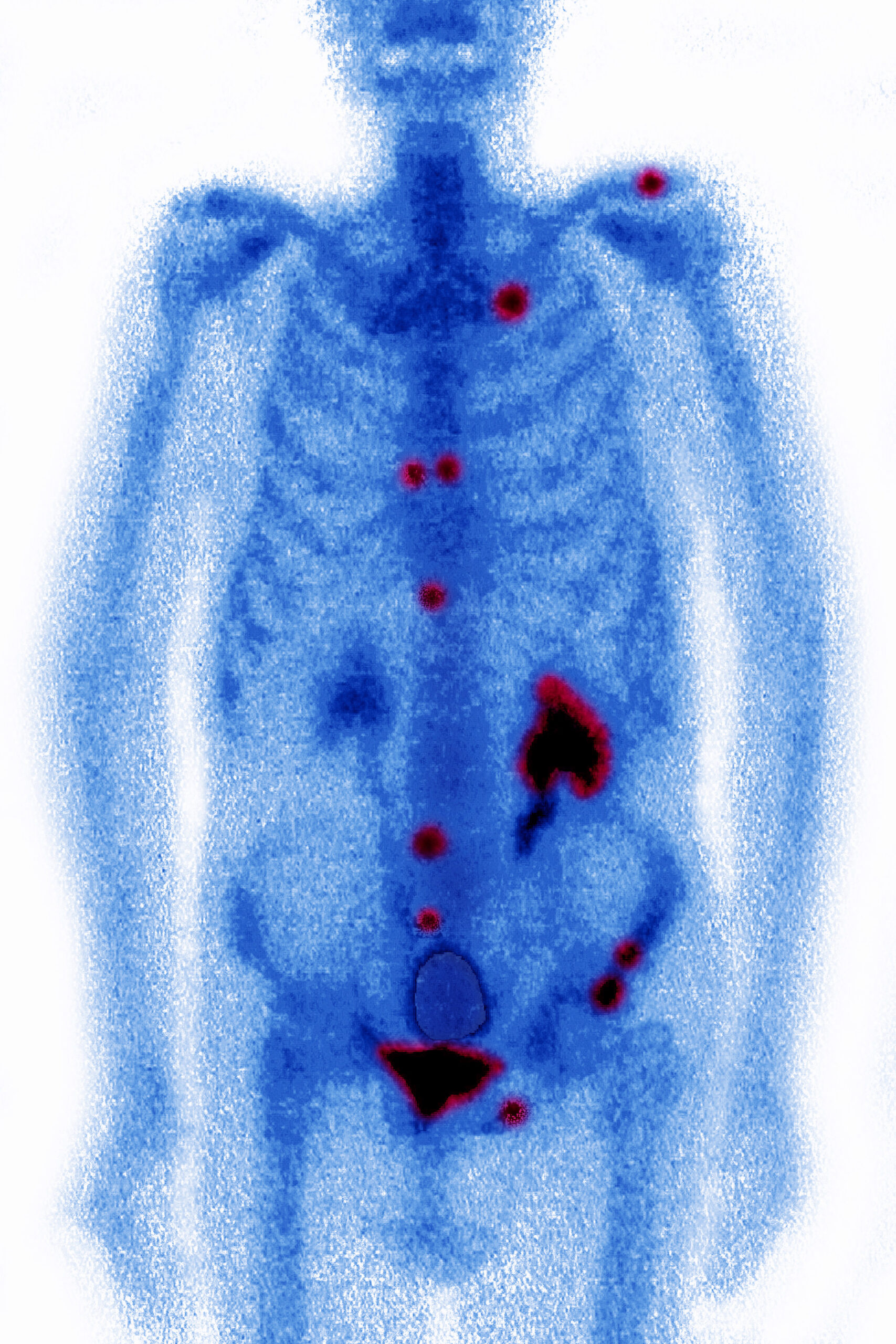 Metastasis, Scintiscan