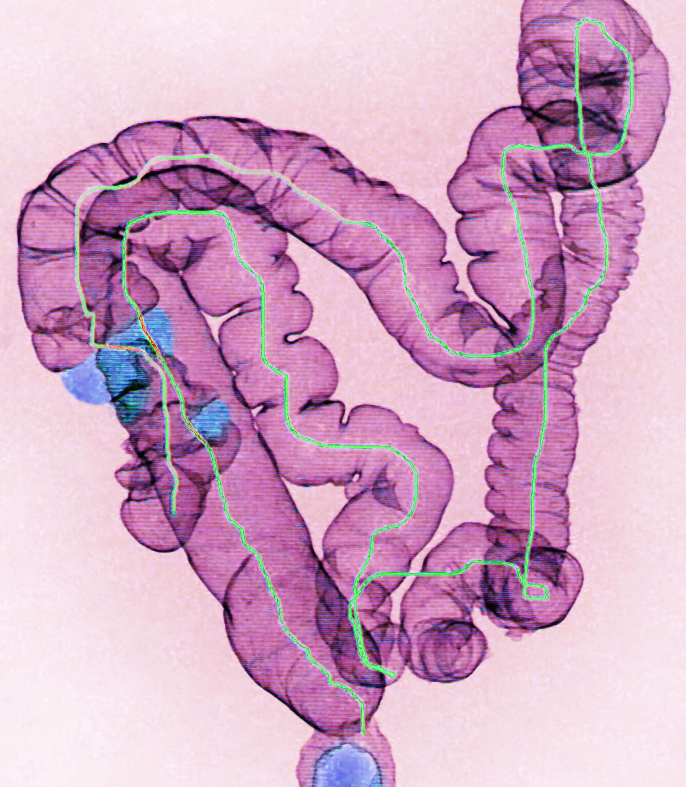 Colon Cancer Ct Scan