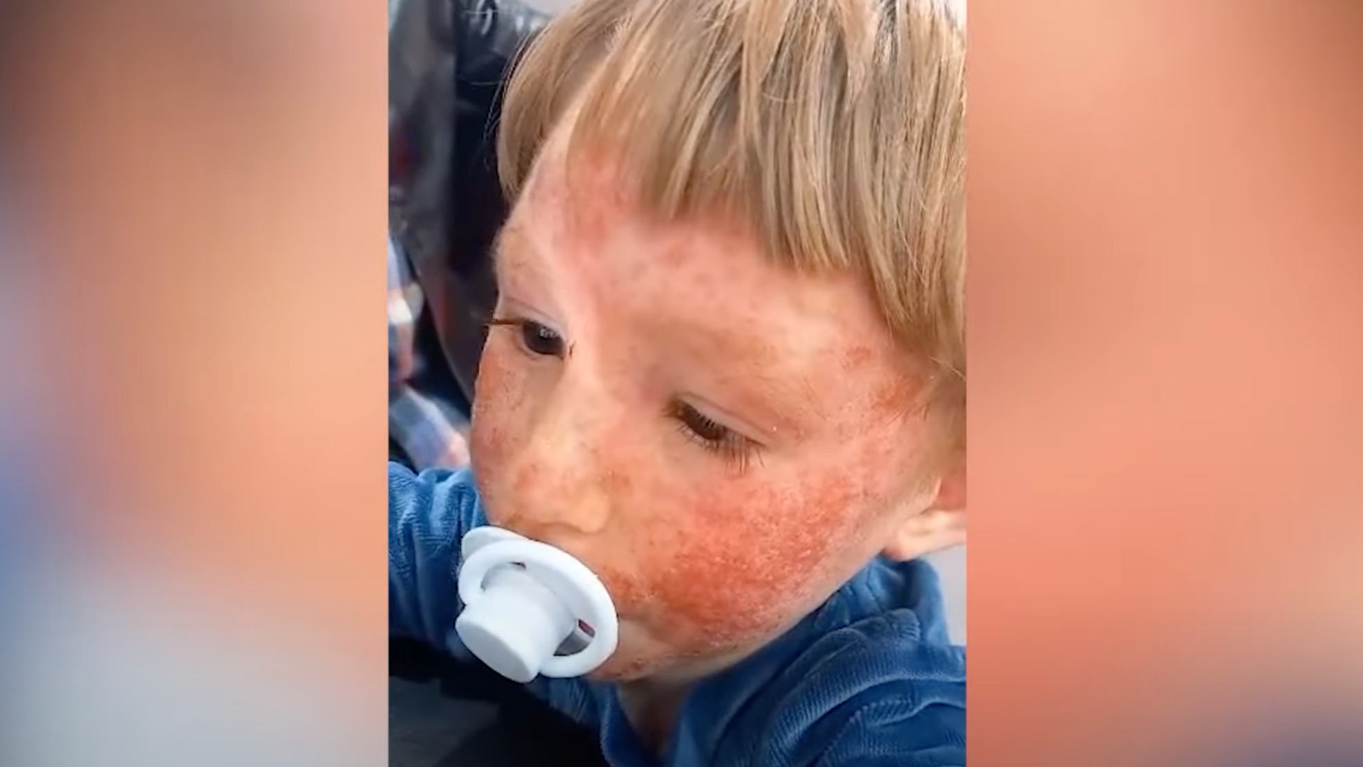Young toddler with eczema