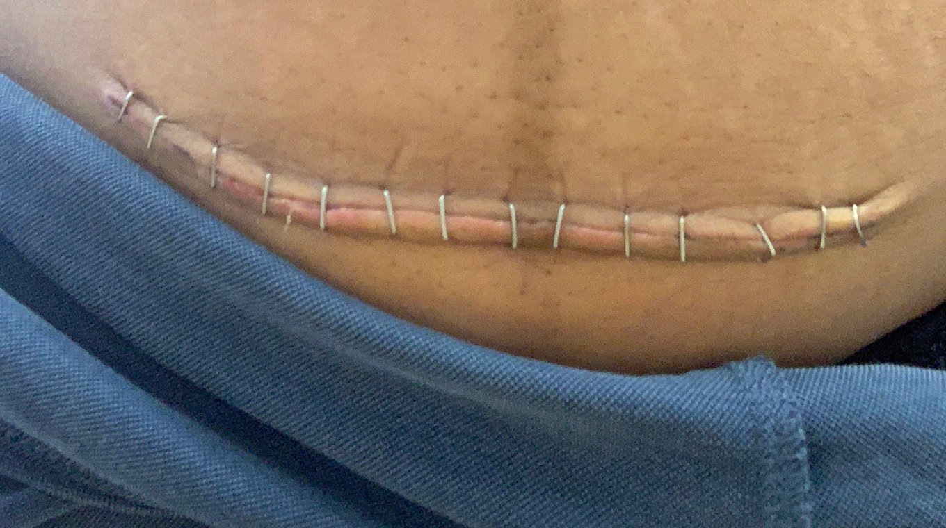 c-section-scar-veena-4th-trimester.jpg