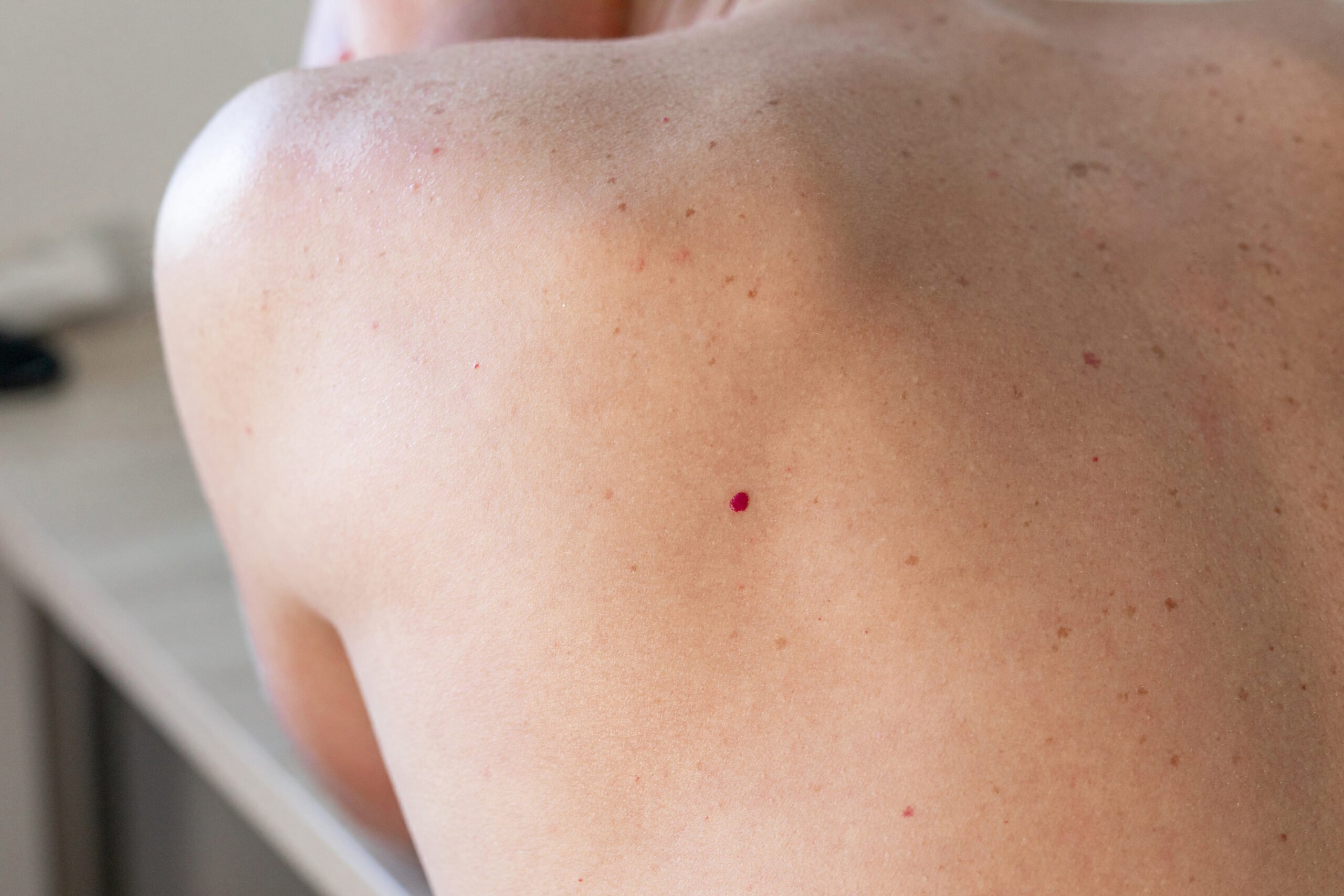 cherry angiomas
