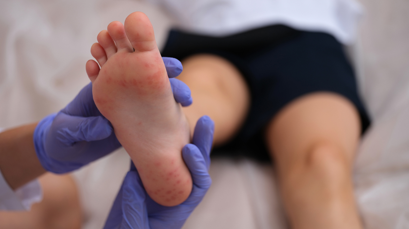 kids_hand_foot_and_mouth_disease_1b.jpg